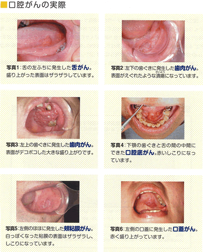 が 舌 でこぼこ ふち の ベロの横が波うっている！舌圧痕の２つ原因
